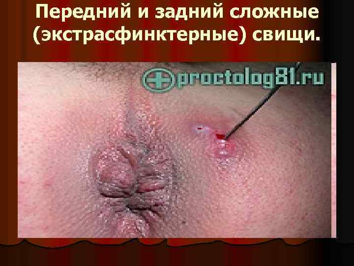 Передний и задний сложные (экстрасфинктерные) свищи. 