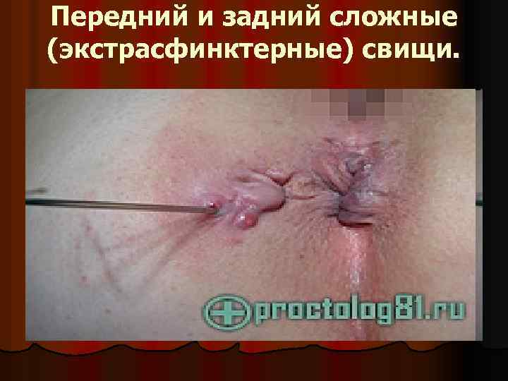 Передний и задний сложные (экстрасфинктерные) свищи. 