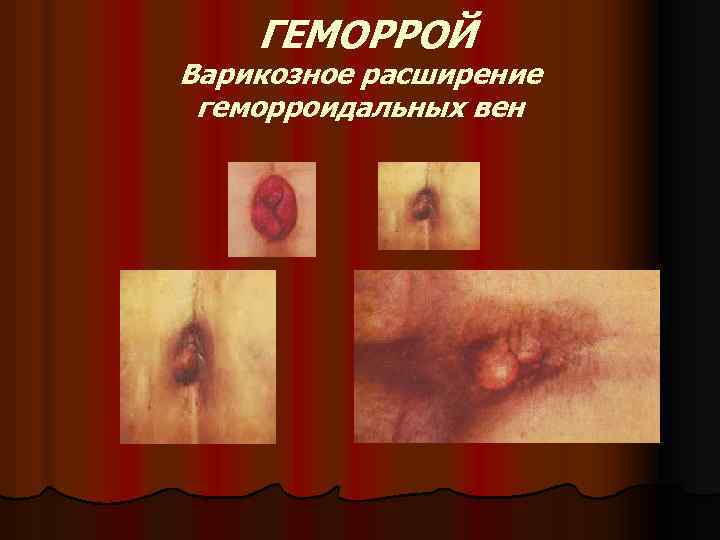 ГЕМОРРОЙ Варикозное расширение геморроидальных вен 