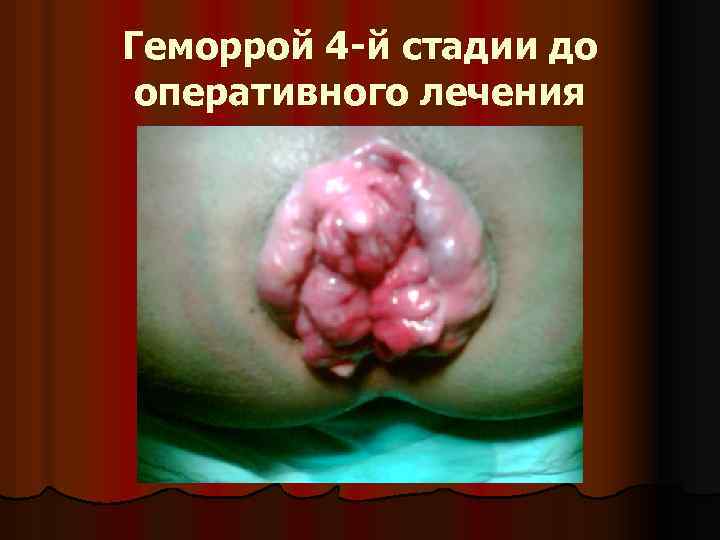 Геморрой 4 -й стадии до оперативного лечения 