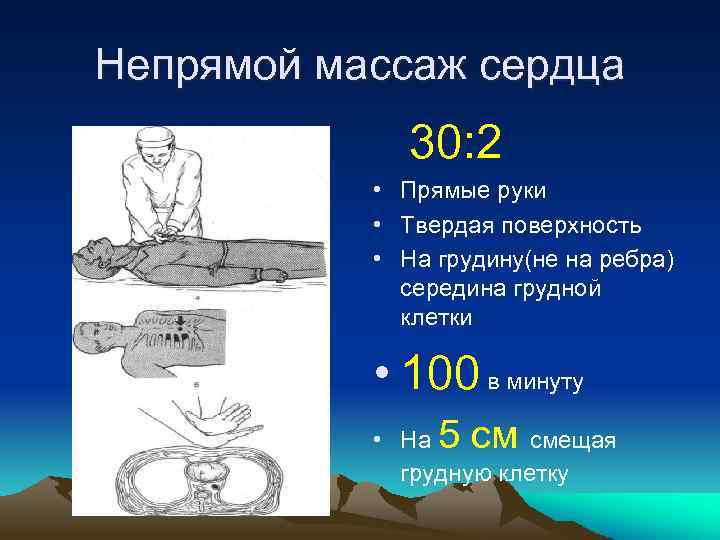 Непрямой массаж сердца 30: 2 • Прямые руки • Твердая поверхность • На грудину(не