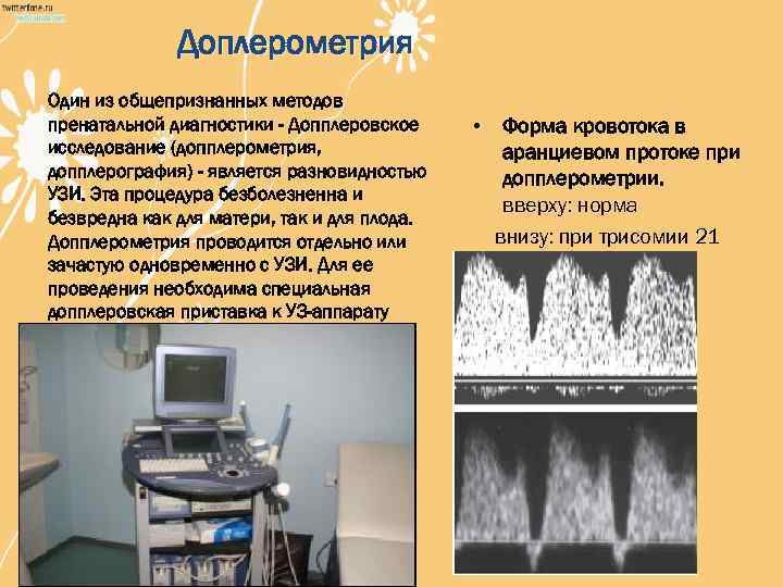 Доплерометрия Один из общепризнанных методов пренатальной диагностики - Допплеровское исследование (допплерометрия, допплерография) - является