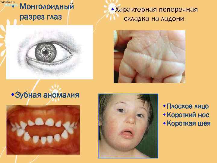  • Монголоидный разрез глаз • Характерная поперечная складка на ладони • Зубная аномалия