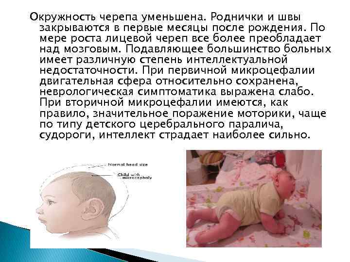 Окружность черепа уменьшена. Роднички и швы закрываются в первые месяцы после рождения. По мере