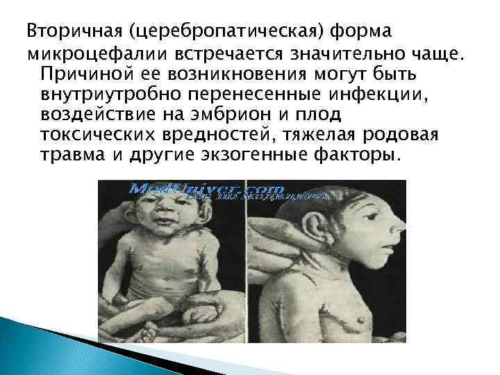 Вторичная (церебропатическая) форма микроцефалии встречается значительно чаще. Причиной ее возникновения могут быть внутриутробно перенесенные