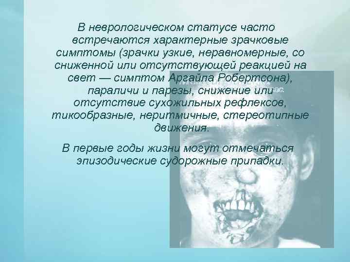 В неврологическом статусе часто встречаются характерные зрачковые симптомы (зрачки узкие, неравномерные, со сниженной или