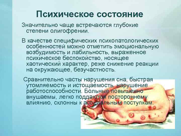 Психическое состояние Значительно чаще встречаются глубокие степени олигофрении. В качестве специфических психопатологических особенностей можно