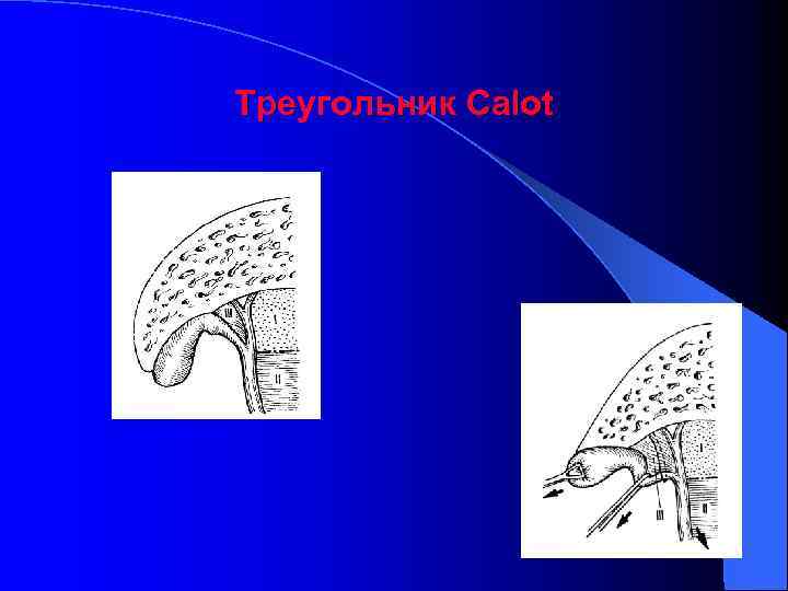 Треугольник Calot 