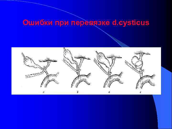 Ошибки при перевязке d. cysticus 