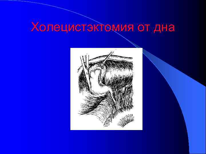 Холецистэктомия от дна 