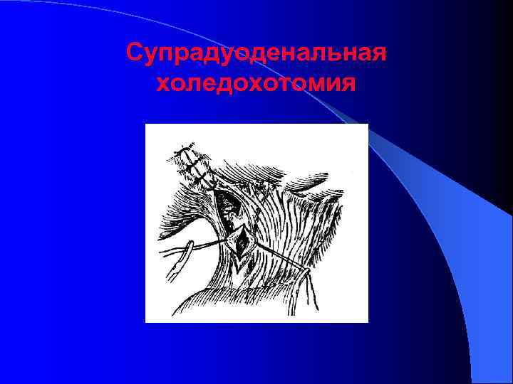 Супрадуоденальная холедохотомия 