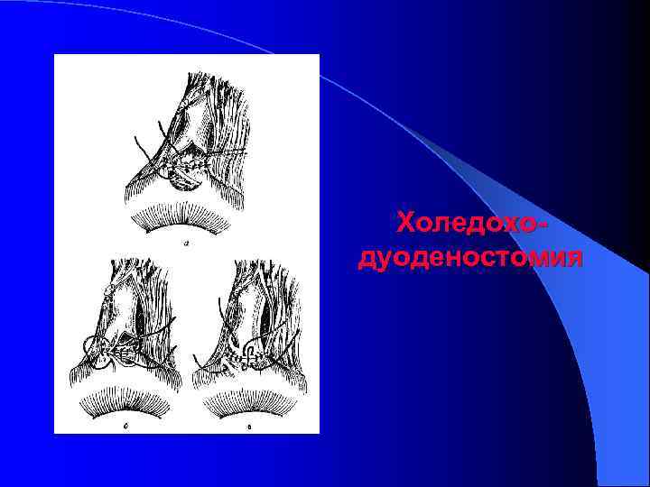 Холедоходуоденостомия 