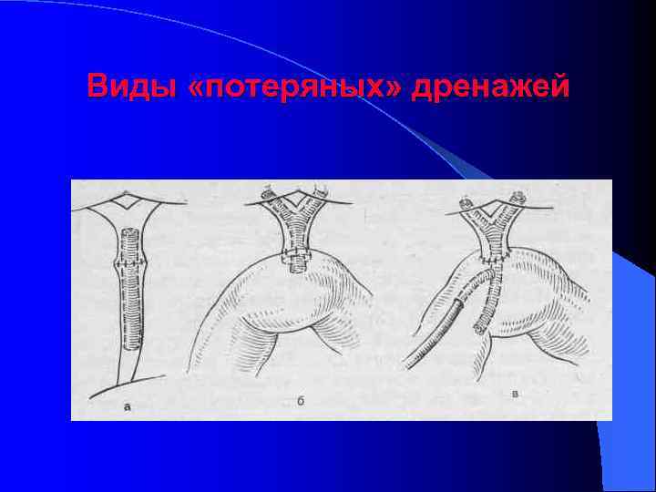 Виды «потеряных» дренажей 