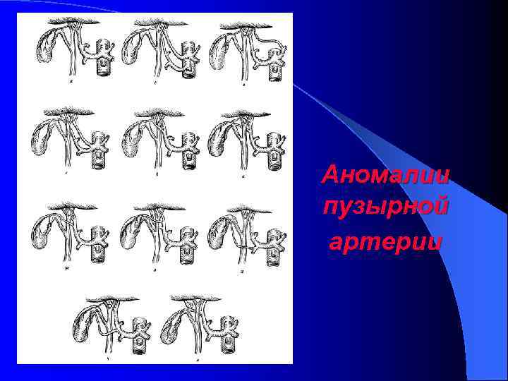 ü Литтманн, 583 Аномалии пузырной артерии 