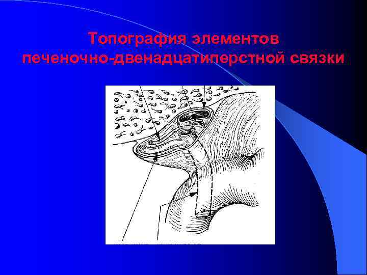 Топография элементов печеночно-двенадцатиперстной связки 