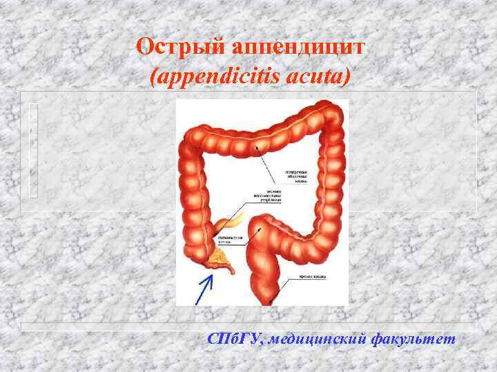Острый аппендицит (appendicitis acuta) СПб. ГУ, медицинский факультет 