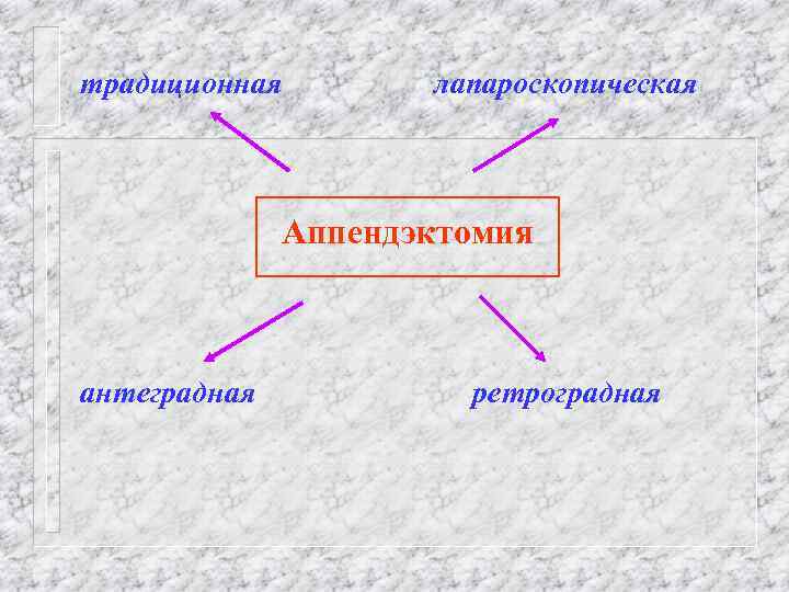 традиционная лапароскопическая Аппендэктомия антеградная ретроградная 