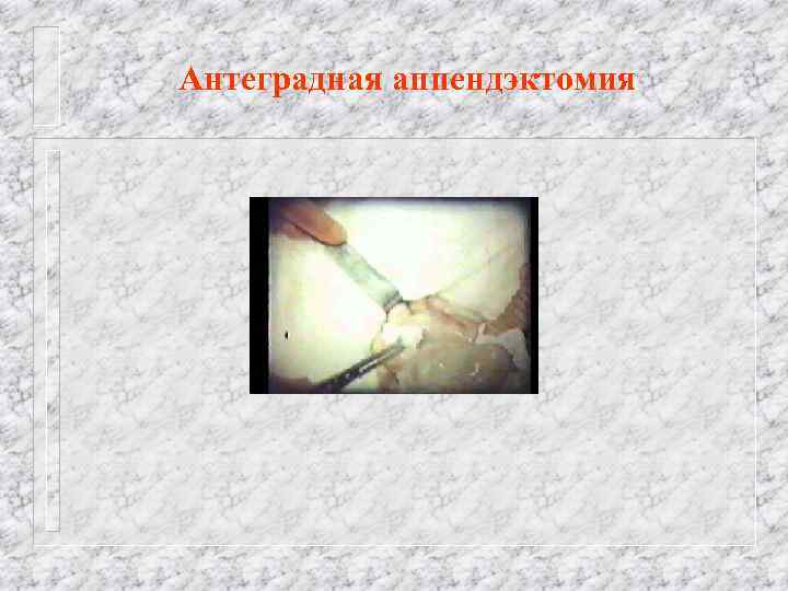 Антеградная аппендэктомия 