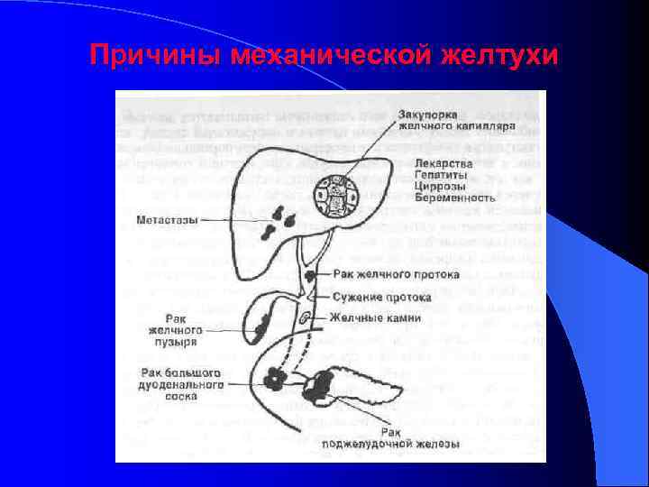 Механическая желтуха. Причины механической желтухи. Холецистит механическая желтуха. Причины развития механической желтухи. Механизм возникновения механической желтухи.