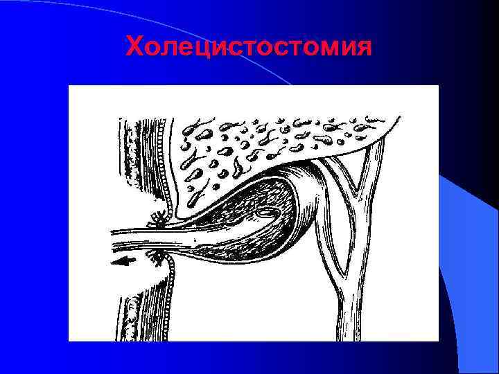 Холецистостомия 