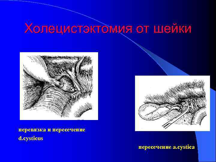 Холецистэктомия от шейки перевязка и пересечение d. cysticus пересечение a. cystica 