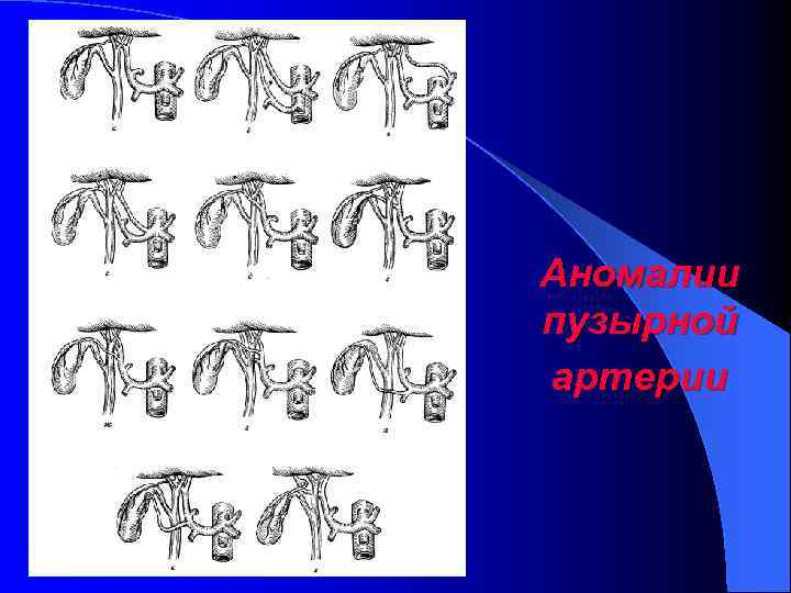 ü Литтманн, 583 Аномалии пузырной артерии 