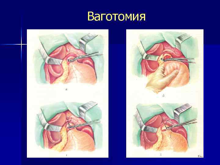 Ваготомия 