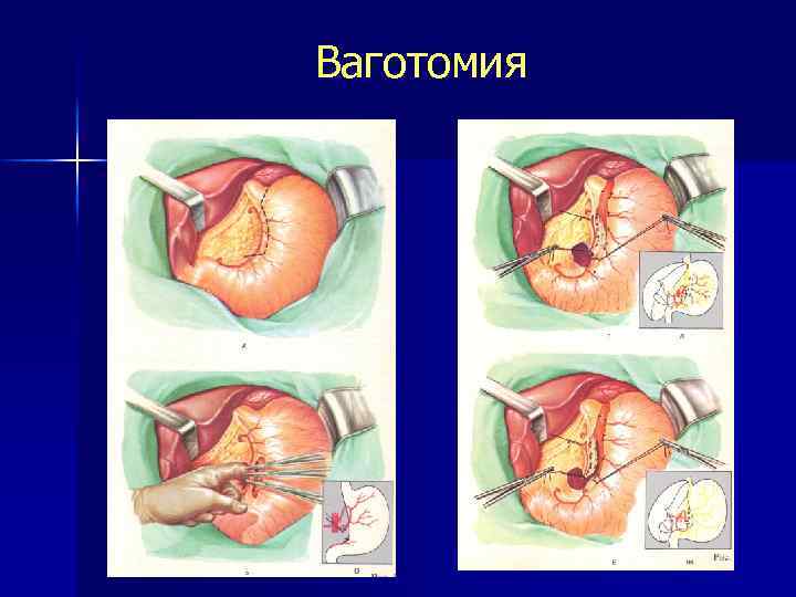 Ваготомия 