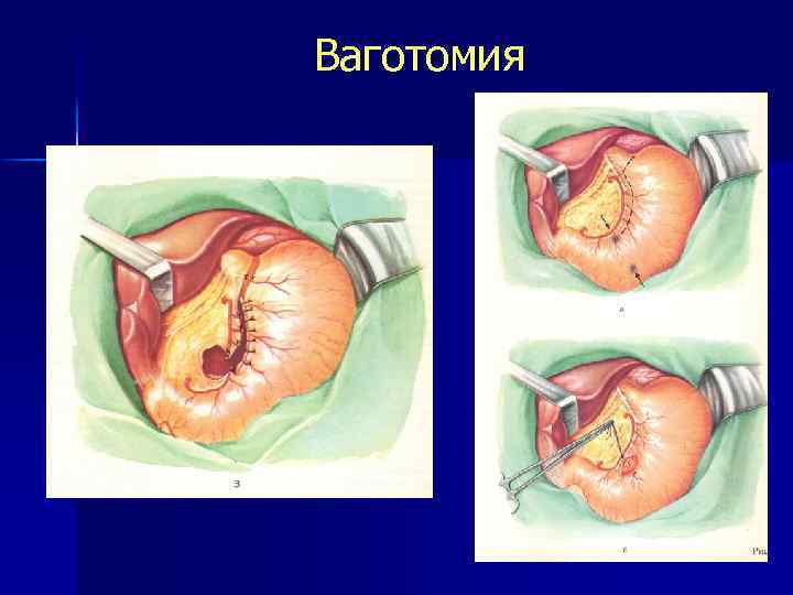 Ваготомия 