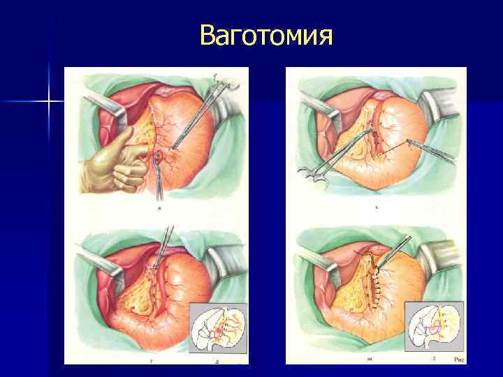 Ваготомия 