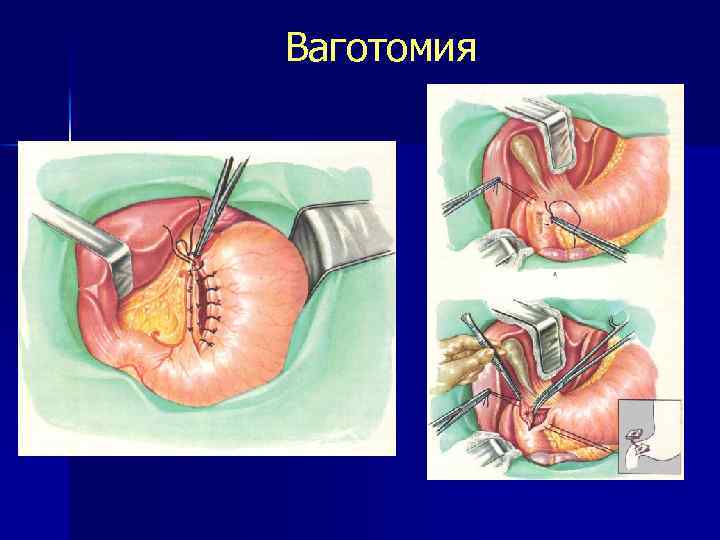 Ваготомия 