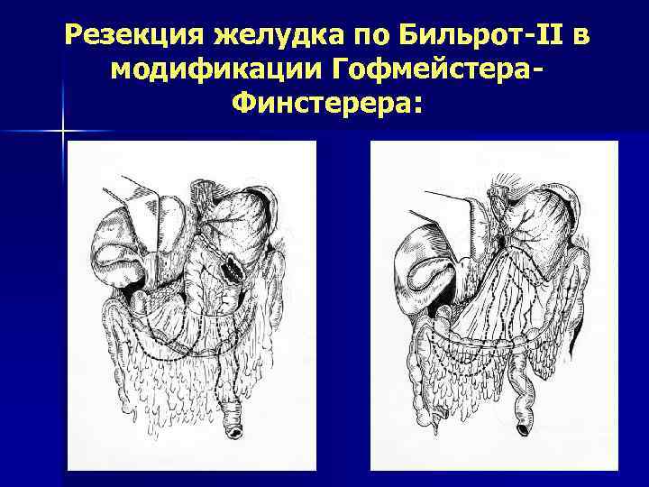 Резекция желудка по Бильрот-II в модификации Гофмейстера. Финстерера: 