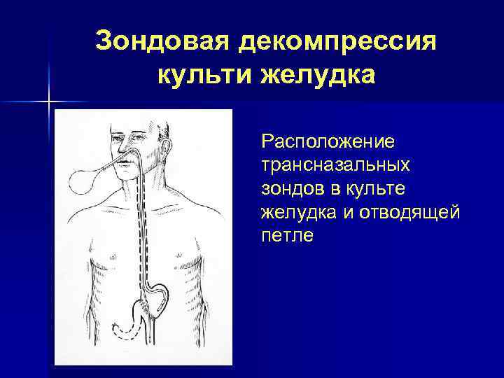 Декомпрессия это. Декомпрессия желудка. Декомпрессия желудка зондом. Декомпрессия желудка катетером. Зондовая декомпрессия кишечника.