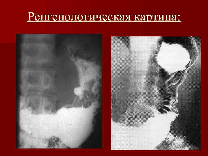 Ренгенологическая картина: 