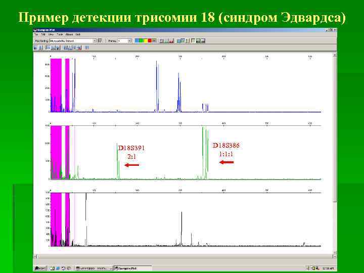 Пример детекции трисомии 18 (синдром Эдвардса) D 21 S 11 1: 1 D 18