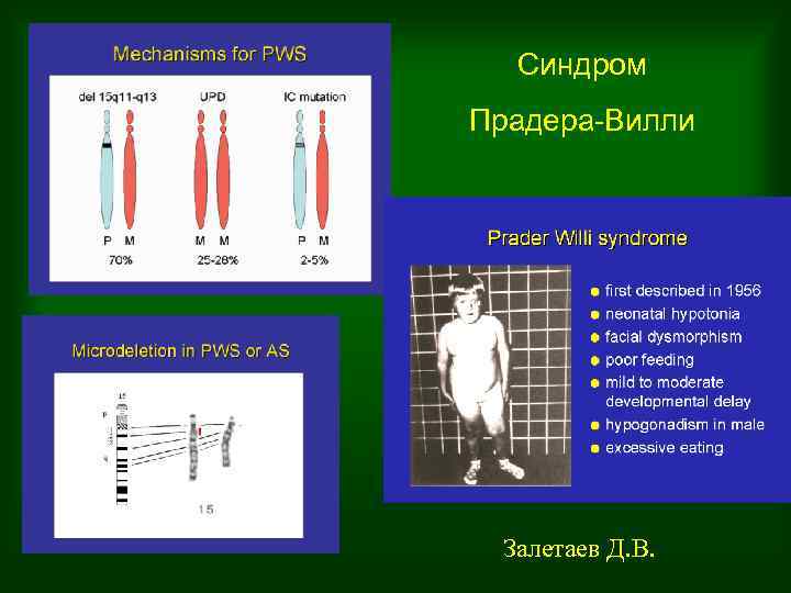 Синдром Прадера-Вилли Залетаев Д. В. 