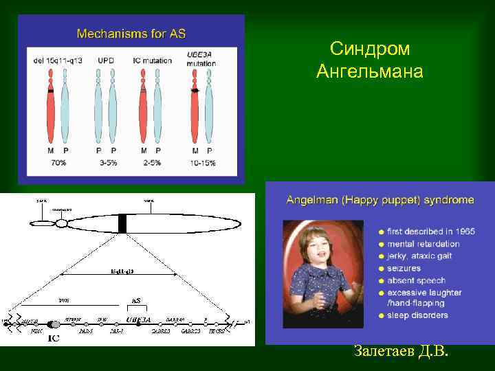 Синдром Ангельмана Залетаев Д. В. 