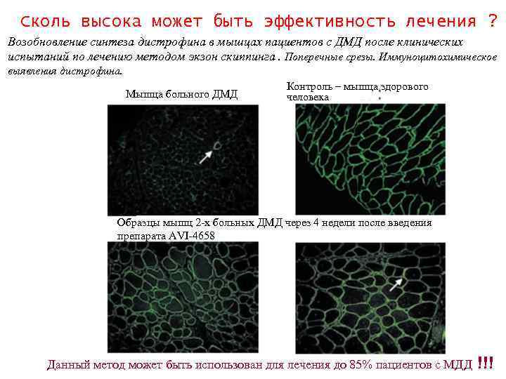 Сколь высока может быть эффективность лечения ? Возобновление синтеза дистрофина в мышцах пациентов с