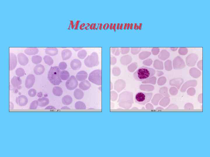 Мегалоциты 