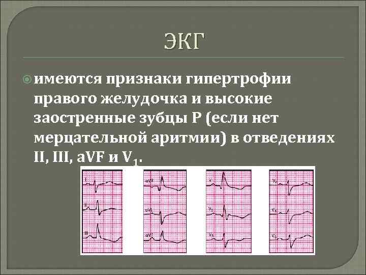 ЭКГ имеются признаки гипертрофии правого желудочка и высокие заостренные зубцы Р (если нет мерцательной