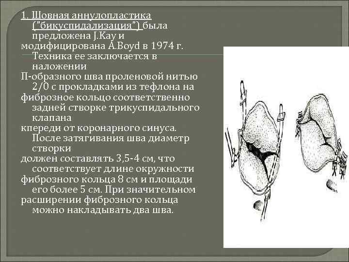 1. Шовная аннулопластика ("бикуспидализация") была предложена J. Kay и модифицирована A. Boyd в 1974