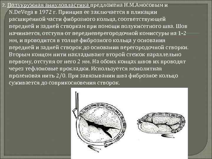 Пластика трикуспидального клапана