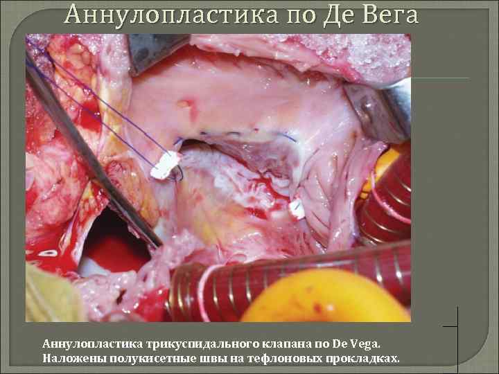 Аннулопластика по Де Вега Аннулопластика трикуспидального клапана по De Vega. Наложены полукисетные швы на