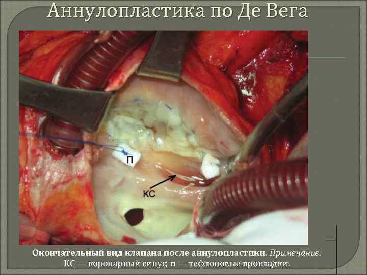 Аннулопластика по Де Вега Окончательный вид клапана после аннулопластики. Примечание. КС — коронарный синус;