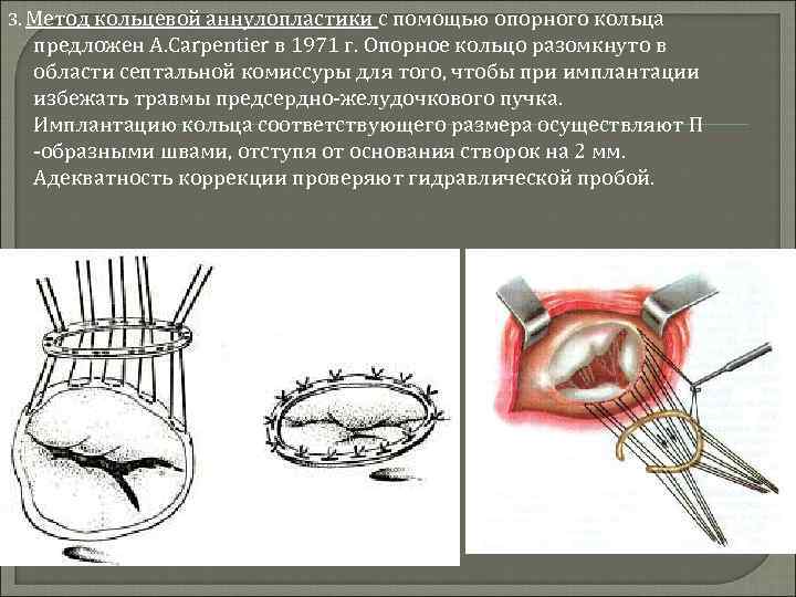 3. Метод кольцевой аннулопластики с помощью опорного кольца предложен A. Carpentier в 1971 г.