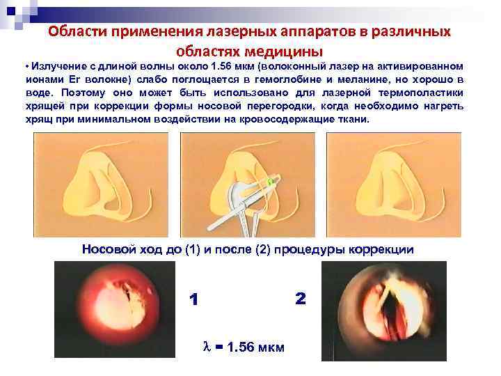 Области применения лазерных аппаратов в различных областях медицины • Излучение с длиной волны около