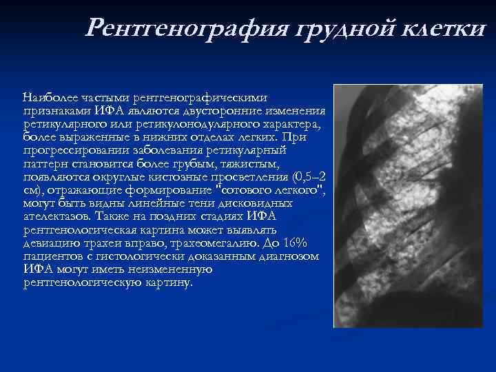 Рентгенография грудной клетки Наиболее частыми рентгенографическими признаками ИФА являются двусторонние изменения ретикулярного или ретикулонодулярного