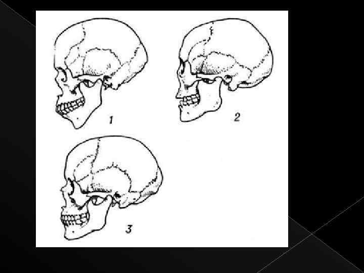 Разные формы черепа. Строение черепа монголоида. Форма черепа у монголоидов. Форма черепа монголоидной расы. Строение черепа человека по Рассам.