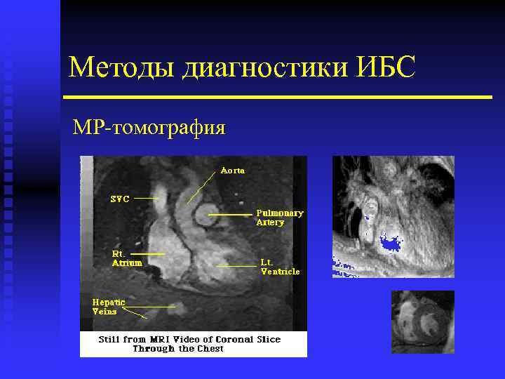Методы диагностики ИБС МР-томография 