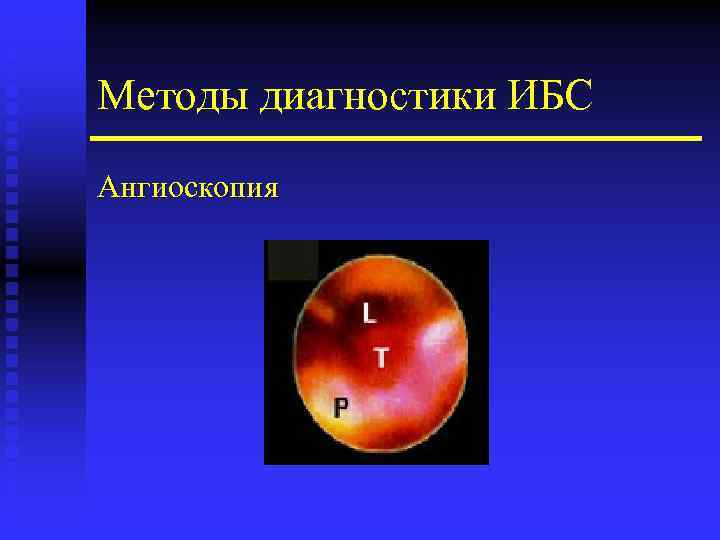 Методы диагностики ИБС Ангиоскопия 